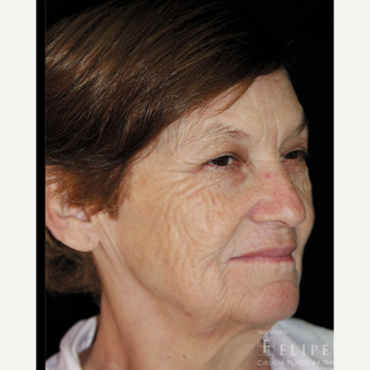 55-64 year old woman treated with Chemical Peel before 3417625
