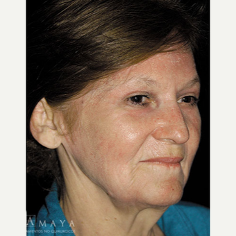 55-64 year old woman treated with Chemical Peel after 3417625