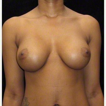 24 year old woman treated with Breast Augmentation before 3103571