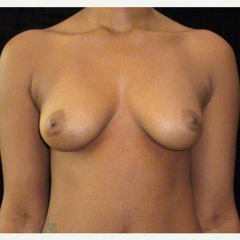 24 year old woman treated with Breast Augmentation after 3103571