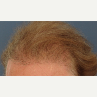 45-54 year old man treated with Hair Transplant after 3065566