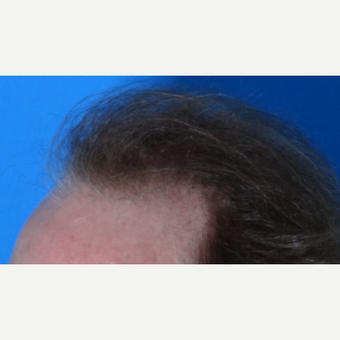 45-54 year old man treated with Hair Transplant before 3065566