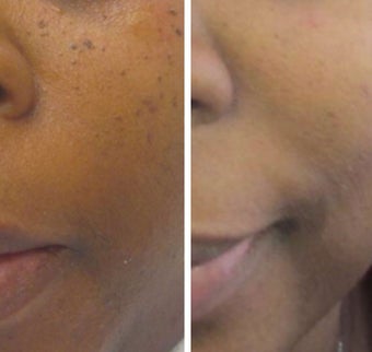 35-44 year old woman treated with Age Spots Treatment for DPNs. after 2697697
