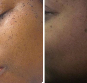 35-44 year old woman treated with Age Spots Treatment for DPNs. before 2697697