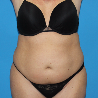 35-44 year old woman treated with Smart Lipo before 3332885