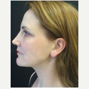 35-44 year old man treated with Ultherapy after 3179912