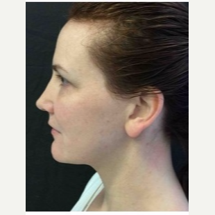 35-44 year old man treated with Ultherapy before 3179912