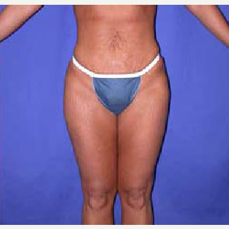 45-54 year old woman treated with SAFELipo after 3126321