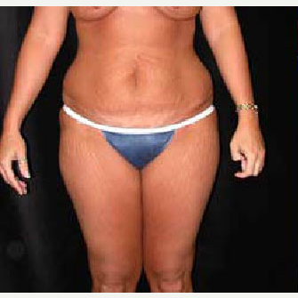 45-54 year old woman treated with SAFELipo before 3126321