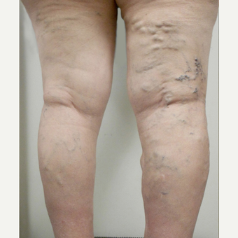 65-74 year old woman treated with EVLT before 3163847