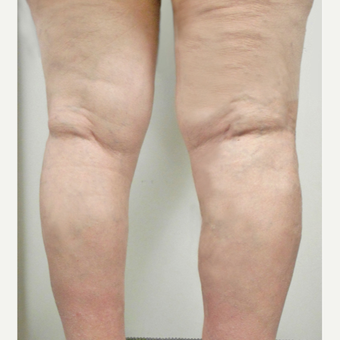 65-74 year old woman treated with EVLT after 3163847