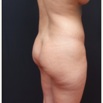 25-34 year old woman treated with Liposuction before 3267153