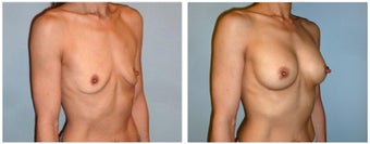 Shaped Implants for 42yr old woman. after 1327505