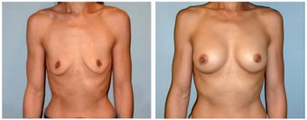 Shaped Implants for 42yr old woman. before 1327505