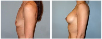 Shaped Implants for 42yr old woman. 1327505