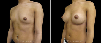 Breast Augmentation after 691594