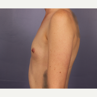 Breast Augmentation before 3663799
