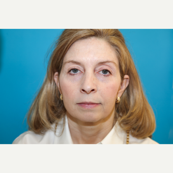 35-44 year old woman treated with Mini Face Lift before 3797179