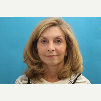 35-44 year old woman treated with Mini Face Lift after 3797179