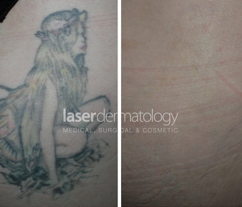Laster tattoo removal before 1332883