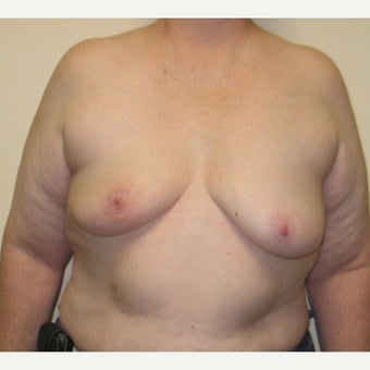 55-64 year old woman treated with Breast Reconstruction before 1925124