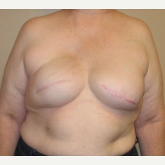 55-64 year old woman treated with Breast Reconstruction after 1925124