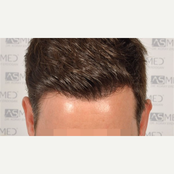 35-44 year old man treated with 2806 Grafts FUE Hair Transplant after 3091515