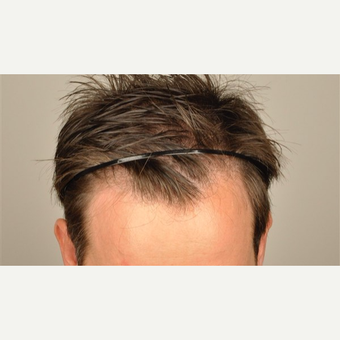 35-44 year old man treated with 2806 Grafts FUE Hair Transplant before 3091515