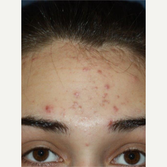 18-24 year old woman treated with LED Acne Treatment before 3174910