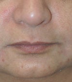 Restylane for marionette (mouth) lines after 91310
