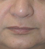 Restylane for marionette (mouth) lines before 91310
