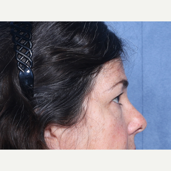 35-44 year old woman treated with Eyelid Surgery (view 2 of 2) before 3180900