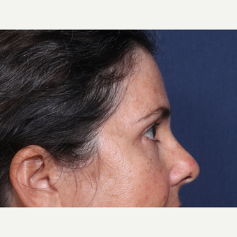 35-44 year old woman treated with Eyelid Surgery (view 2 of 2) after 3180900