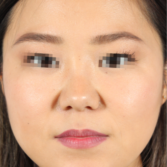 25-34 year old woman treated with Rhinoplasty before 3419583
