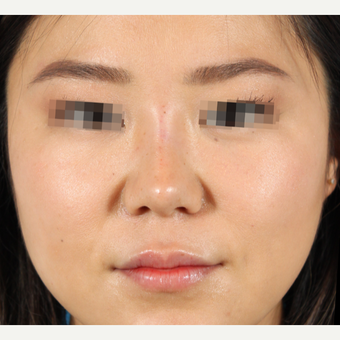 25-34 year old woman treated with Rhinoplasty after 3419583