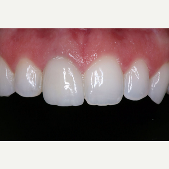 25-34 year old woman treated with Dental Crown after 3629668
