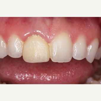 25-34 year old woman treated with Dental Crown before 3629668