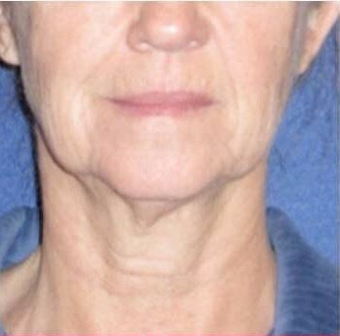 55-64 year old woman treated with Mini Lift before 3758431