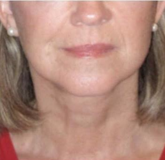 55-64 year old woman treated with Mini Lift after 3758431