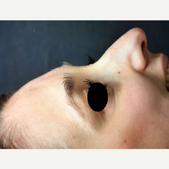 25-34 year old woman treated with Rhinoplasty before 3211852