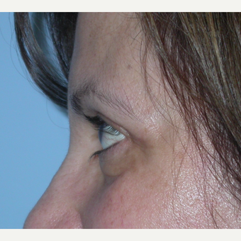 55-64 year old woman treated with Eyelid Surgery after 3070059