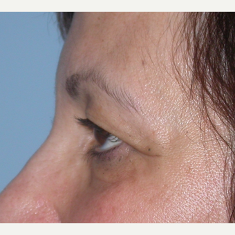 55-64 year old woman treated with Eyelid Surgery before 3070059