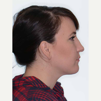 25-34 year old woman treated with Orthognathic Surgery after 2419070