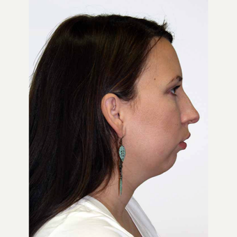 25-34 year old woman treated with Orthognathic Surgery before 2419070