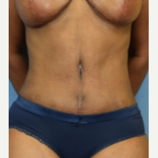 45-54 year old woman treated with Tummy Tuck after 3537202