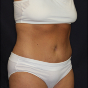 45-54 year old woman treated with Tummy Tuck after 3075313