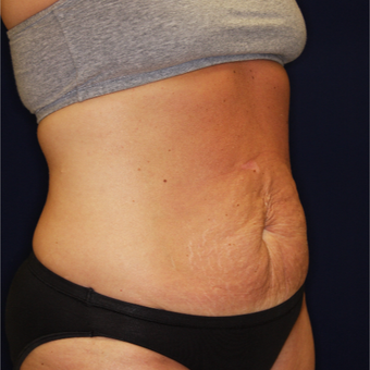 45-54 year old woman treated with Tummy Tuck before 3075313