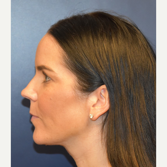 25-34 year old woman treated with Liposuction after 3266343