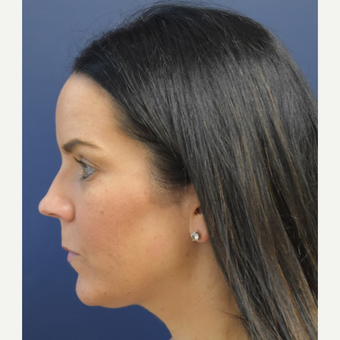 25-34 year old woman treated with Liposuction before 3266343