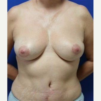 45-54 year old woman treated with Breast Lift after 3037724